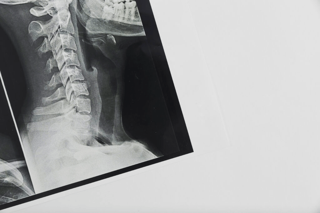 An X-ray film showing a clear side view of the cervical spine and lower skull, displayed against a plain white background, with the vertebrae and neck structure sharply visible.